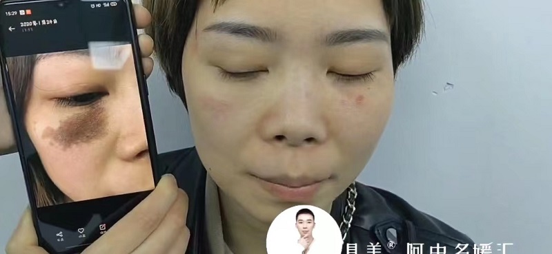 咖啡色胎记
