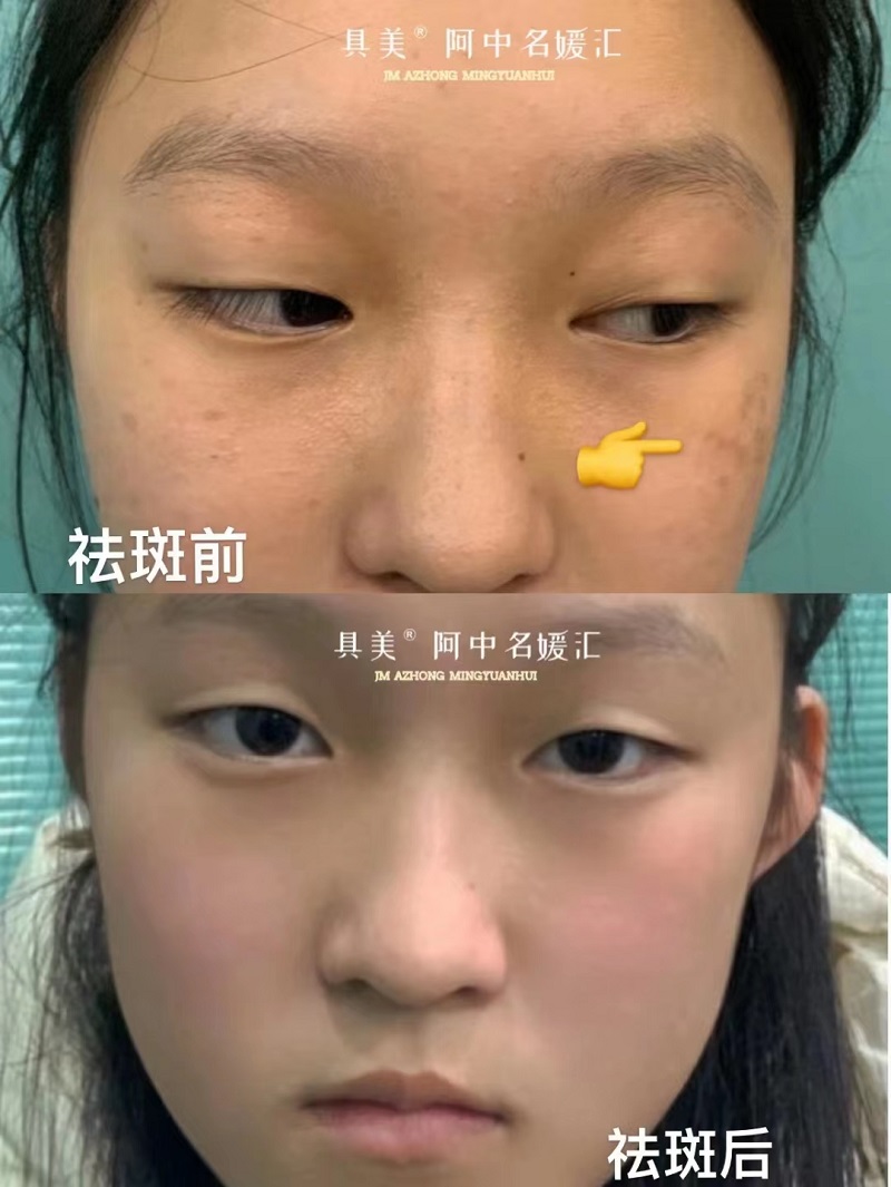褐青色痣